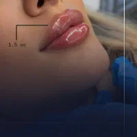 تخفیف بوتاکس فیلر ژل فول فیشال تخصصی توسط دکتر