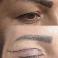 جشنواره بلفاروپلاستی جراحی پلک با بخیه لیزری|خدمات آرایشگری و زیبایی|تهران, شهرک غرب|دیوار