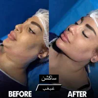 سوپرساکشن غبغب همراه بازاویه سازی تخصصی گردنُ صورت|خدمات آرایشگری و زیبایی|تهران, پاسداران|دیوار