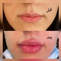 ژل لب زاویه چانه گونه  مزوبوتاکس هایفو لیزرمو زائد|خدمات آرایشگری و زیبایی|مشهد, فرهنگ|دیوار
