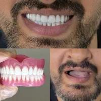 دندان مصنوعی + لابراتوار دندانسازی با گارانتی