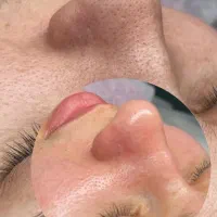 فیشیال +آبرسانی صورت