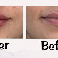 مدل فیلر صورت در کلینیک نوا|خدمات آرایشگری و زیبایی|شیراز, ستارخان|دیوار