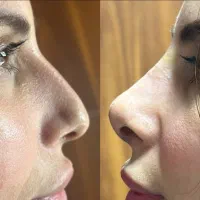 ژل/فیلر/بوتاکس/پی آرپی/بایو فیلر و چربی|خدمات آرایشگری و زیبایی|کرج, گوهردشت|دیوار