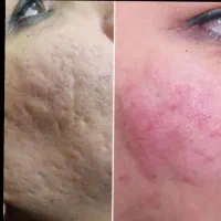 تخفیف ویژه بوتاکس، ژل، پی آر پی، رفع کک و مک|خدمات آرایشگری و زیبایی|بوکان, |دیوار