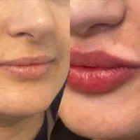 تخفیف ویژه ژل و فیلر|خدمات آرایشگری و زیبایی|گلبهار, شهر جدید گلبهار|دیوار