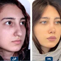 عمل بینی با چک و سفته