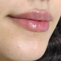فیلر لب نچرال