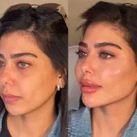 کلینیک پوست زعفرانیه نسل جدید بوتاکس گازی نخ فیلر|خدمات آرایشگری و زیبایی|تهران, زعفرانیه|دیوار