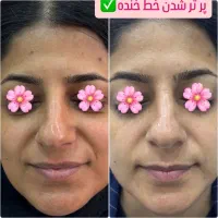 روشن سازی با لیزر پیکوشور و پاک کردن تتو|خدمات آرایشگری و زیبایی|هندیجان, |دیوار