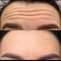 ژل و بوتاکس و مزو ژل|خدمات آرایشگری و زیبایی|بومهن, |دیوار