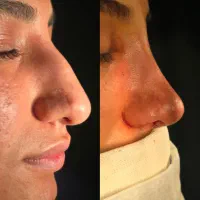 جراحی بینی و پلک، لیفت ابرو و شقیقه، لیفت صورت|خدمات آرایشگری و زیبایی|خوی, |دیوار