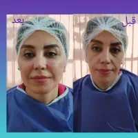 تزریق چربی .بلفارو
