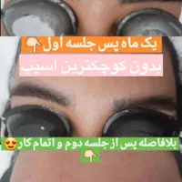 لیزر پاکسازی تتو روشن سازی تخصصی صورت و نواحی تیره|خدمات آرایشگری و زیبایی|قم, زنبیل آباد|دیوار