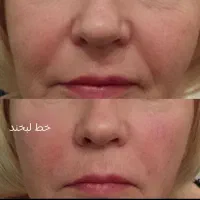 تزریق ژل .بوتاکس .انزیم بینی .مزوژل جوانساز|خدمات آرایشگری و زیبایی|جهرم, |دیوار