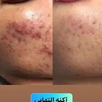 ژل وبوتاکس ولیزر وفشیال وخالبرداری ومزونیدلینگ|خدمات آرایشگری و زیبایی|تبریز, |دیوار