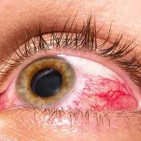 درمان دیابت (قند خون) صددرصد تضمینی