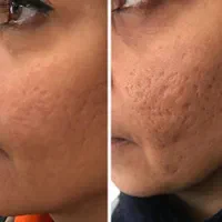 اندولیفت/ جوانسازی /تخلیه چربی صورت / رفع سلولیت|خدمات آرایشگری و زیبایی|تهران, صادقیه|دیوار