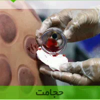 حجامت وفصد خون درمنزل در قرچک   پذیرفته میشود|خدمات آرایشگری و زیبایی|قرچک, |دیوار