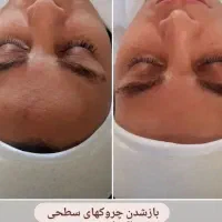 پاکسازی وآبرسانی پوست باتخفیف|خدمات آرایشگری و زیبایی|مرند, |دیوار