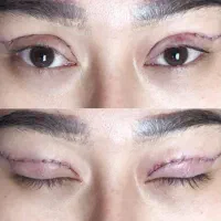 جشنواره تخفیفی بلفاروپلاستی رویان