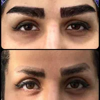 کاشت مو شیرازی و کاشت ابرو تخصصی