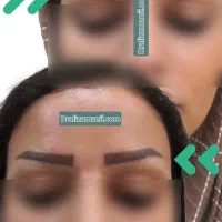 بلفاروپلاستی کاشت ابرو کاشت مو تخفیف|خدمات آرایشگری و زیبایی|تهران, دریاچه شهدای خلیج فارس|دیوار