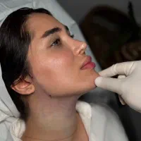 غبغب تخفیف ویژه  برای رفع غبغب شعبه اصلی مهرزاد