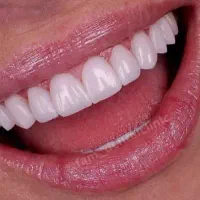 کامپوزیت دندان/اقساط/آف ویژه|خدمات آرایشگری و زیبایی|اصفهان, جلفا|دیوار
