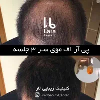 پی آر پیPRP درمان ریزش مو مزوتراپی هیرفیلر کاشت مو|خدمات آرایشگری و زیبایی|تهران, صادقیه|دیوار