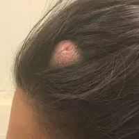 جراحی توده ها و ضایعات پوستی و لیپوم (متخصص جراحی)