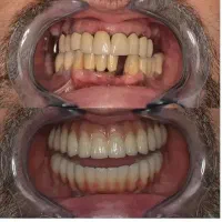 اقساط دندانپزشکی بدون پرداخت پول کلیه خدمات