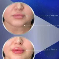 تزریق انواع فیلر بوتاکس مزوژل ها توسط پزشک