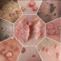 پک درمان زگیل تناسلی کاملا گیاهی و صددرصد تضمینی