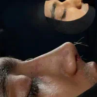 عمل جراحی بینی وترمیم بدون کبودی با پیزو/لیفت|خدمات زیبایی و سلامت|کرج, چهارصد دستگاه|دیوار