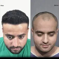 اقساطی کاشت مو تضمینی/کاشت ابرو کاشت