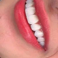 کاشت جراحی بینی غبغب سانترال دایرکت لمینت کامپوزیت|خدمات آرایشگری و زیبایی|قم, سالاریه|دیوار