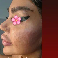 تزریق ژل بوتاکس|خدمات آرایشگری و زیبایی|شیراز, نصرآباد|دیوار