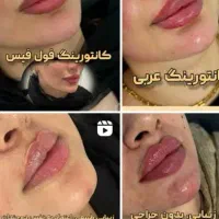 ژل فیلر صورت