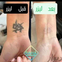 کلینیک پاک کردن تاتو(لیزرتضمینی)دریک جلسه/ریموابرو|خدمات آرایشگری و زیبایی|مشهد, احمدآباد|دیوار