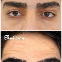 بوتاکس|خدمات آرایشگری و زیبایی|سنقر, |دیوار