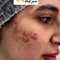 فیشال تخصصی بانوان وآقایان،خالبرداری،حذف کک ومک|خدمات آرایشگری و زیبایی|شیراز, عفیف‌آباد|دیوار
