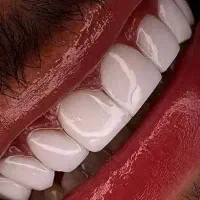 کامپوزیت  دندان در محل شما