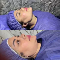 جشنواره ویژه ساکشن غبغب وبوکال وغیره...