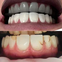 (زیبایی) ونییر کامپوزیت و لمینیت، بلیچینگ|خدمات آرایشگری و زیبایی|رشت, گلسار|دیوار