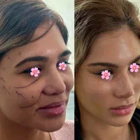 لیفت شقیقه و صورت|خدمات آرایشگری و زیبایی|اهواز, کیان اباد|دیوار