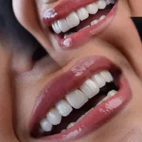 کاشت ایمپلنت تخصصی/دندانپزشکی فوق حرفه ای