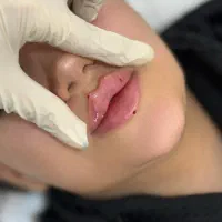 جشنواره تزریق چربی و ژل لب M