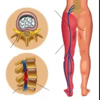 اگر به دنبال علاج دیسک کمر هستید تماس بفرمایید