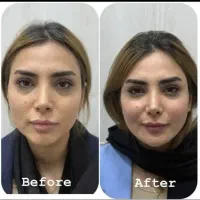 مرکز تخصصی جوانسازی فقط در ۱ جلسه/هایفو/لیفت ۸۹۰ت